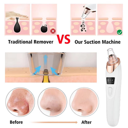Revolutionary Blackhead Remover Vacuum: Your Ultimate Electric Pore Cleaner for Flawless Skin!