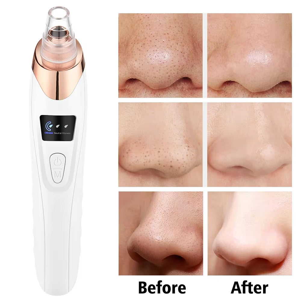 Revolutionary Blackhead Remover Vacuum: Your Ultimate Electric Pore Cleaner for Flawless Skin!